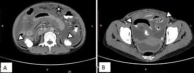 Fig. 15. Case of “wet type” of tuberculous peritonitis. A and B. Smudge pattern of greater omental involvement (star) with smooth peritoneal thickening and enhancement. Thickened serosal surface of small and large bowel loops (arrow heads) with ascites.[2]