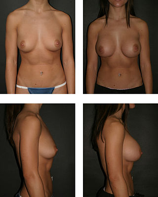 <span class="mw-page-title-main">Breast augmentation</span> Surgical procedure