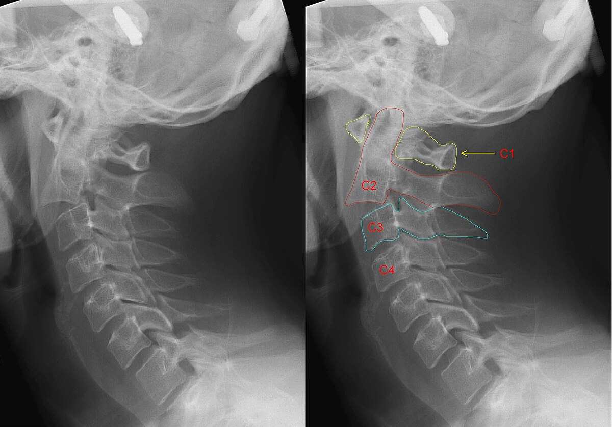 Hangman's fracture - Wikipedia rib  damage diagram 