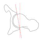 Transverse and sagittal angles of acetabular inlet plane.