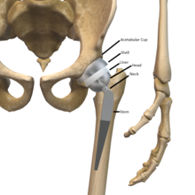 Different parts of hip prosthesis Hip Prostesis.png