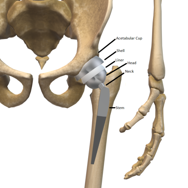 File:Hip Prostesis.png