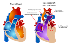 Vlevo: normální srdce, vpravo: syndrom hypoplastického levého srdce.
