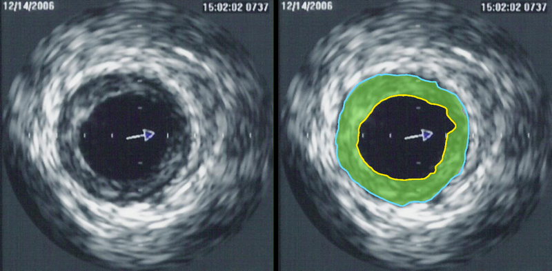 File:IVUS of CAD.png