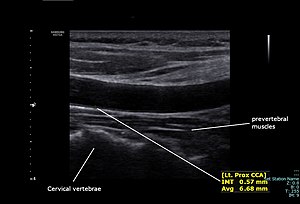 Common Carotid Artery