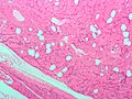 Thumbnail for File:Lipoleiomyoma1.jpg