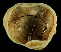Mature cystic teratoma of ovary.jpg