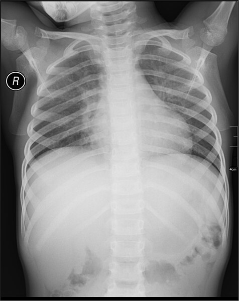 File:Medical X-Ray imaging AME02 nevit.jpg