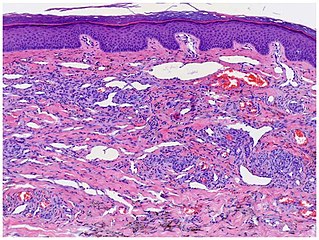 Micrograph of plaque stage, with bizarre vessels dissecting the upper dermis. There is erythrocyte extravasation and hemosiderin pigmentation.[15]