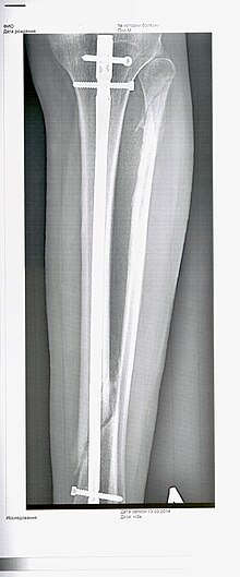 radiographie d'une jambe humaine montrant une fracture basse du tibia et haute du péroné, stabilisées par un clou tibial central et trois vis, et un début de formation de cal aux deux endroits fracturés