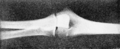 PSM V56 D0682 X ray photo of an elbow joint.png