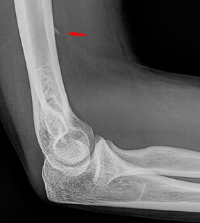 Supracondylar process of the humerus