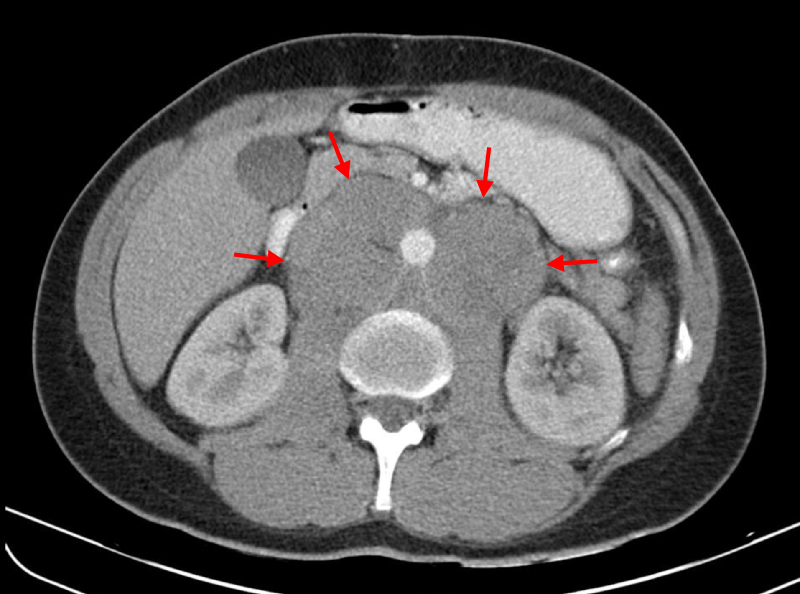 File:Retroperitoneal lymphadenopathy of testicular seminoma, 1 50, CT image.svg