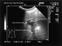 Gallenkolik Schwangerschaft