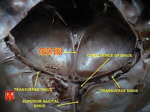 Straight sinus.jpg