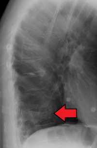 Compression fracture of T12