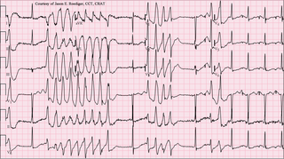 <span class="mw-page-title-main">Torsades de pointes</span> Type of abnormal heart rhythm