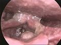 Cancer du larynx (endoscopie)