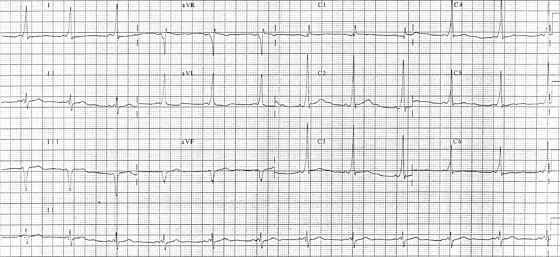 File:Wolff-Parkinson-White syndrome 12 lead EKG.png