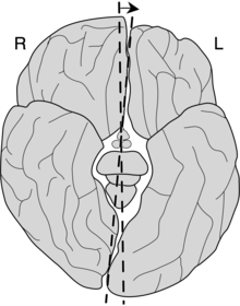 The Yakovlevian torque in the cerebrum (exaggerated). Redrawn from Toga & Thompson. Mapping brain asymmetry. Nat. Rev. Neurosci. 4, 37-48 (2003). DOI 10.1038/nrn1009. YakovlevianTorque.png