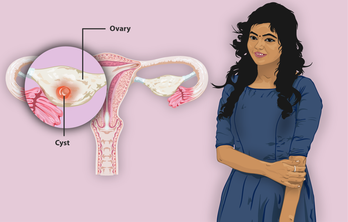 uterine cysts