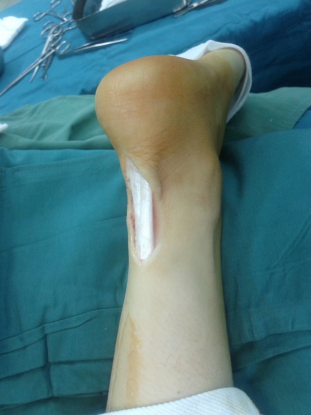 Achilles tendon rupture - Wikipedia