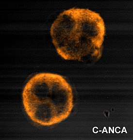 Immunofluorescence pattern produced by binding of ANCA from a patient with Wegener's Granulomatosis to ethanol-fixed neutrophils