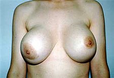 Breast-implant failure: Capsular contracture is a medical complication, in this case, a Baker scale Grade IV contraction, of a subglandular silicone implant in the right breast. Capsular fibrosis.jpg