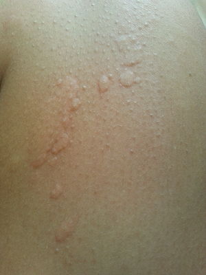 Dingin urticaria3.jpg