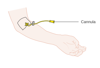 <span class="mw-page-title-main">Cannula</span> Tube surgically implanted in the body