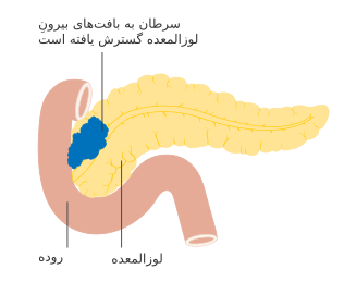 مرحلهٔ T3 سرطان لوزالمعده