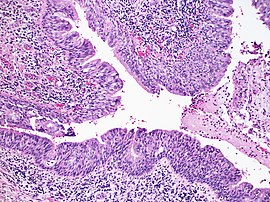 Dysplasia of bronchial epithelium (9277035341).jpg