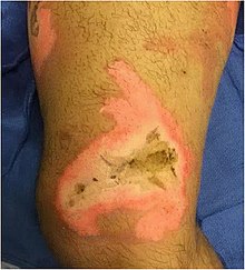 Obrázek popáleniny kůže na středním pravém stehně nad kolenem 35letého muže.