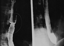 The barium swallow of the esophagus on the left side shows multiple rings associated with eosinophilic esophagitis. Eosinophilic esophagitis-barium swallow.jpg