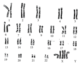 Foetal karyotype demonstrating pentasomy X.png