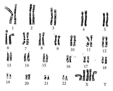 Pentasomy X