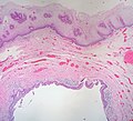 Thumbnail for Vaginal epithelium