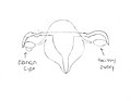 This is a diagram of how an ovary looks with a cyst.