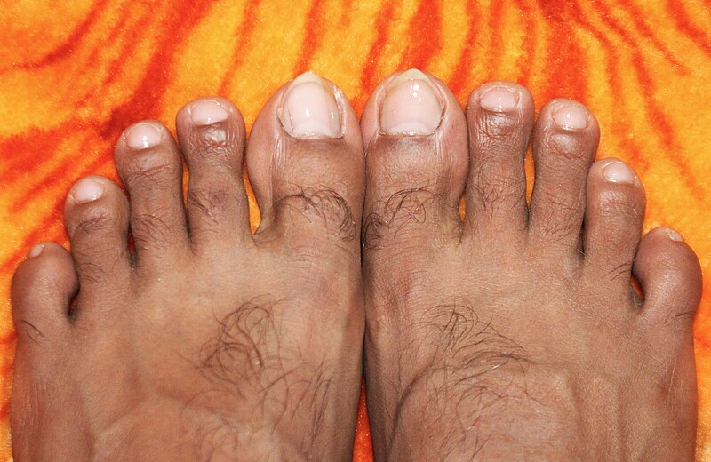 File:Human toenails.jpg