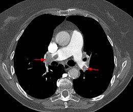 Lungenarterienembolie in der Computertomographie.jpg