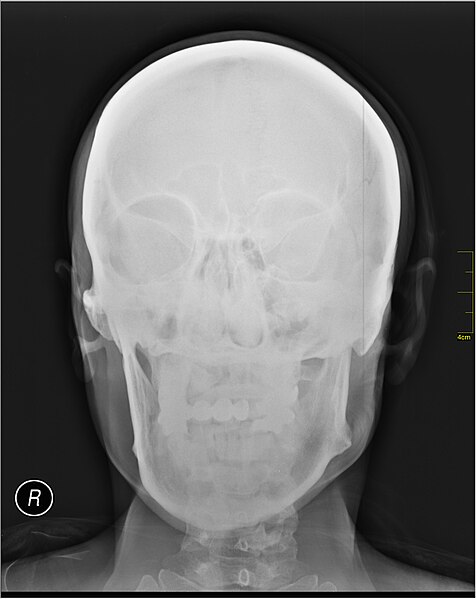 File:Medical X-Ray imaging QXU06 nevit.jpg