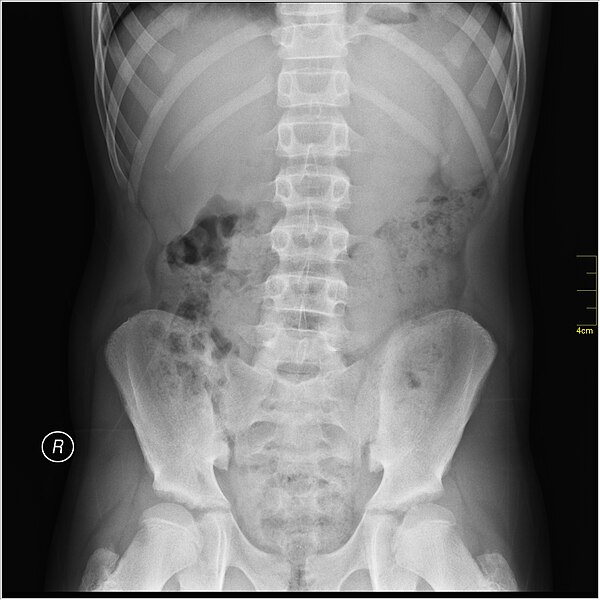 File:Medical X-Ray imaging UCS07 nevit.jpg