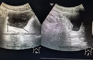 <span class="mw-page-title-main">Neurogenic bladder dysfunction</span> Bladder disorder due to disease or injury of the nervous system