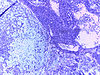 Pleomorphic Adenoma Salivary gland 10x.jpg