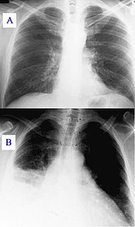 Pulmonary consolidation radiologic sign