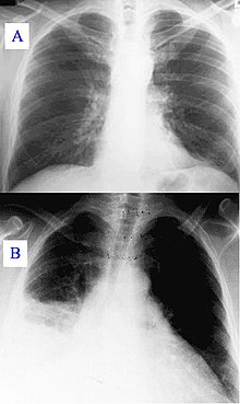 Реферат: Острая внебольничная правосторонняя очаговая пневмония в нижней доле (история болезни)