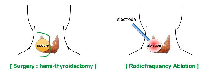 Surgery vs ablation