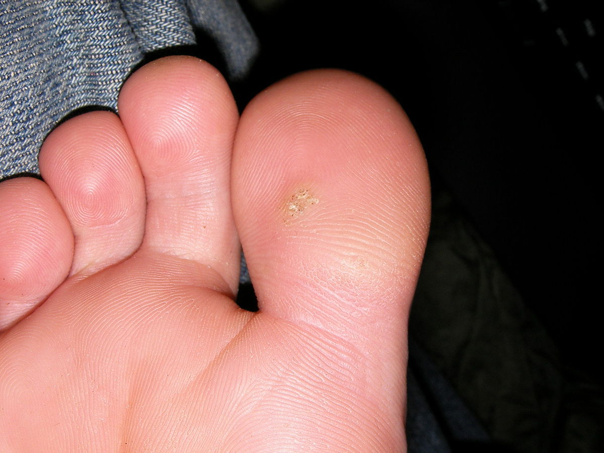 foot warts under toes