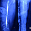 Two postoperative radiographs of a patient who underwent rodding surgery for osteogenesis imperfecta.png