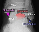 Accessory bones of the ankle. Accessory bones of the ankle.jpg